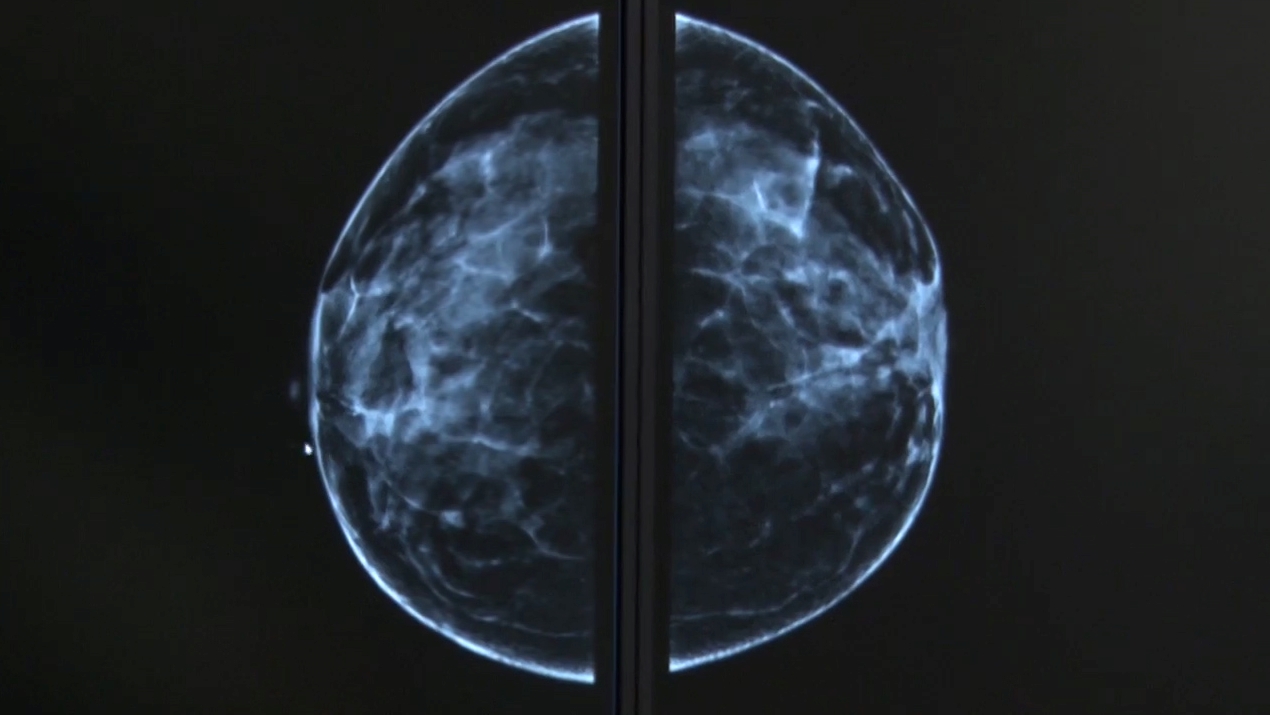 Campanie de mamografii gratuite. Încă un spital s-a alăturat investigațiilor