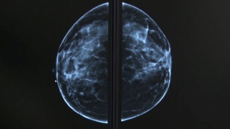 Campanie de mamografii gratuite. Încă un spital s-a alăturat investigațiilor