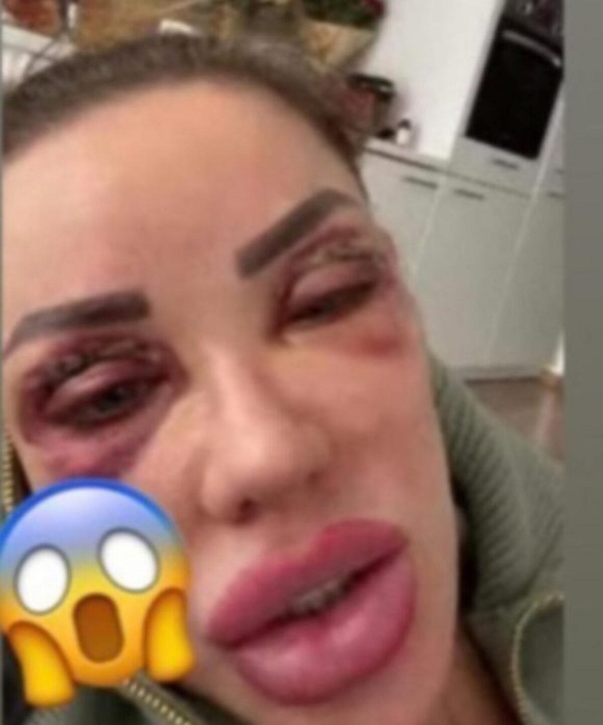 Bianca Drăgușanu a ajuns de urgență la spital. I s-au umflat ochii și fața. Ce se întâmplă cu cea mai tare blondă a României