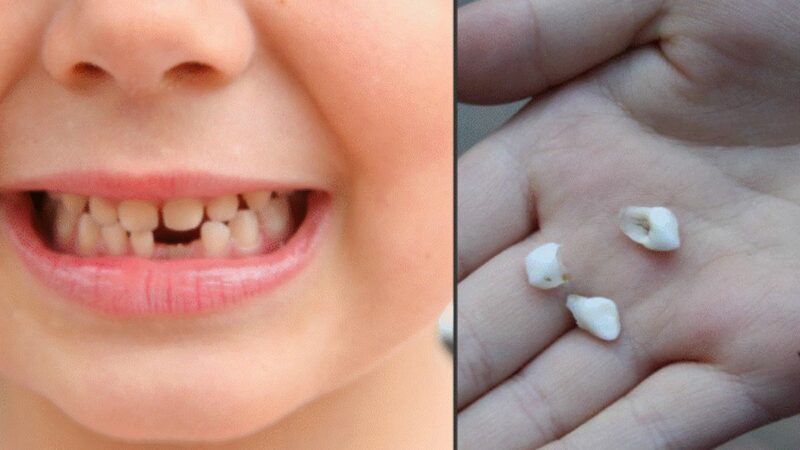 Dinții de lapte ai copiilor nu se aruncă. Pot vindeca numeroase boli pe care micuții le pot face