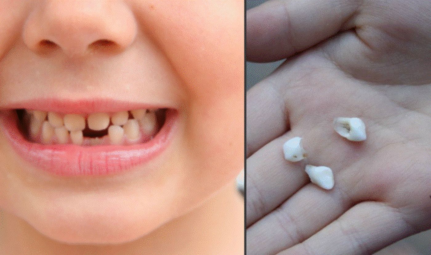 Dinții de lapte ai copiilor nu se aruncă. Pot vindeca numeroase boli pe care micuții le pot face