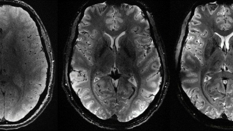Premieră mondială. Au fost dezvăluite primele imagini ale creierului uman obținute cu cel mai puternic RMN din lume