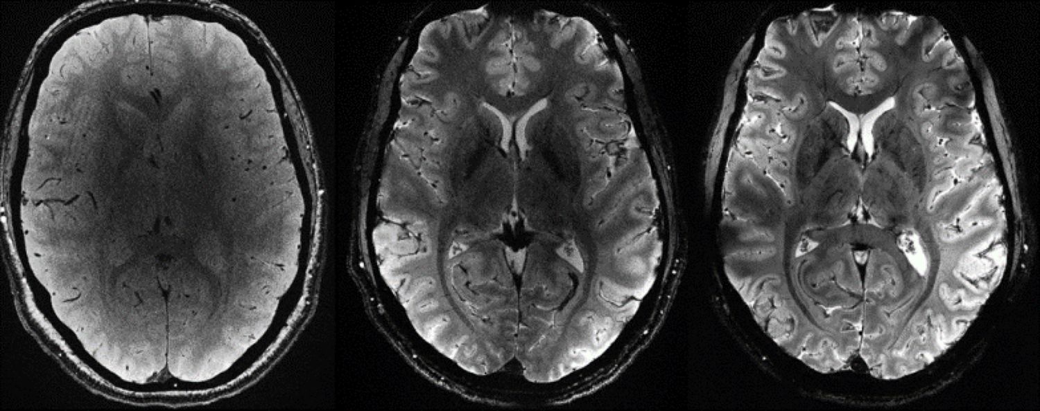 Premieră mondială. Au fost dezvăluite primele imagini ale creierului uman obținute cu cel mai puternic RMN din lume