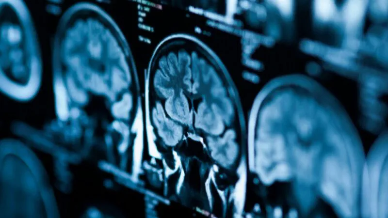 Studiu șocant! Adolescența creierului durează până la 32 de ani