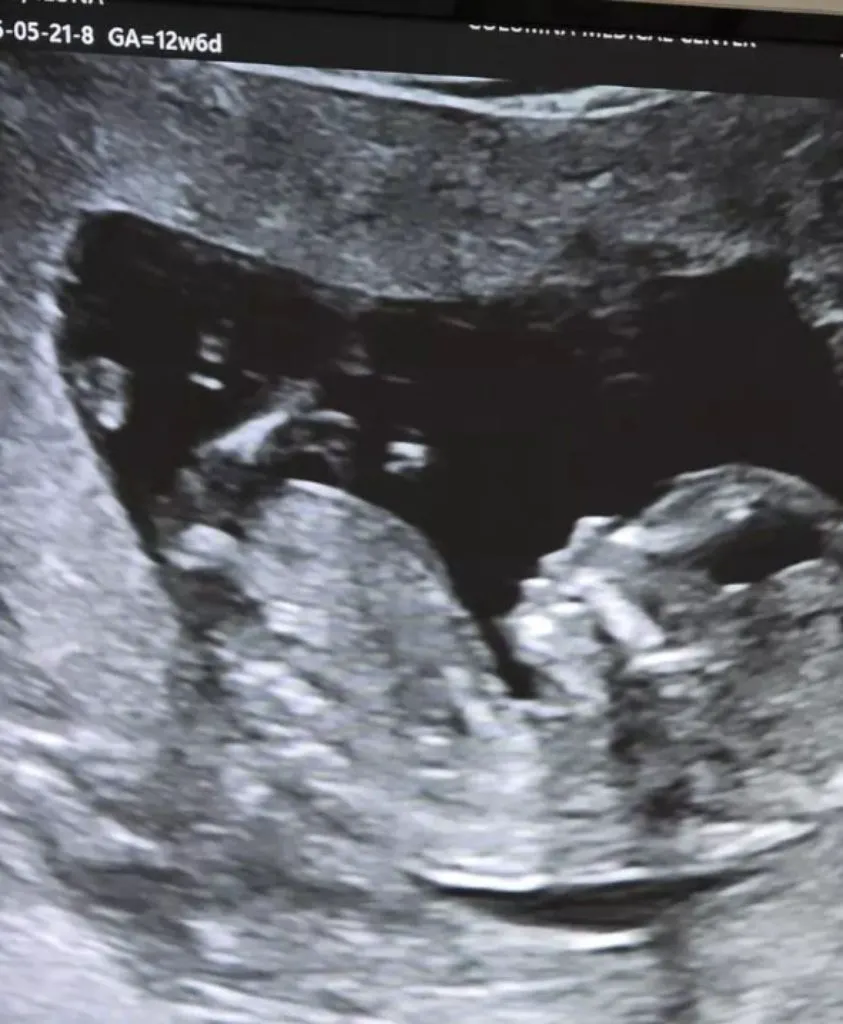 Ilona Brezoianu a născut copilul „cu nasu’ mare”