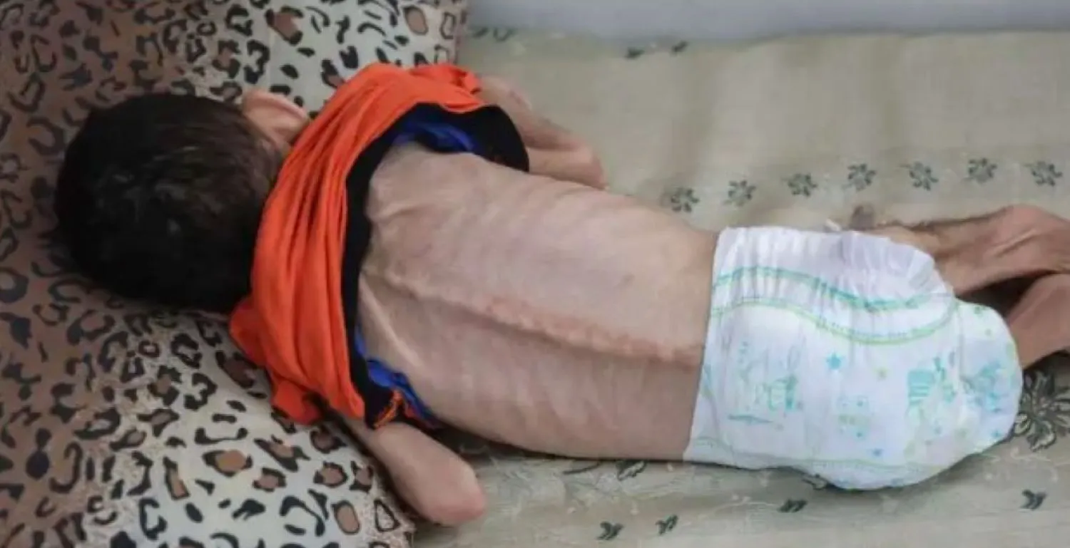 Oamenii de știință au descoperit diabetul de tip 5. Afectează 25 de milioane de persoane la nivel mondial