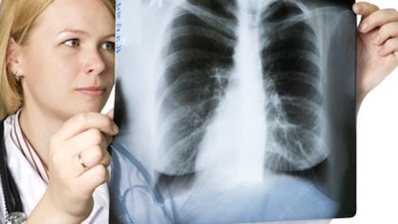 Studiu unic în România. Cercetătorii au descoperit un fenomen alarmant în legătură cu o formă de cancer