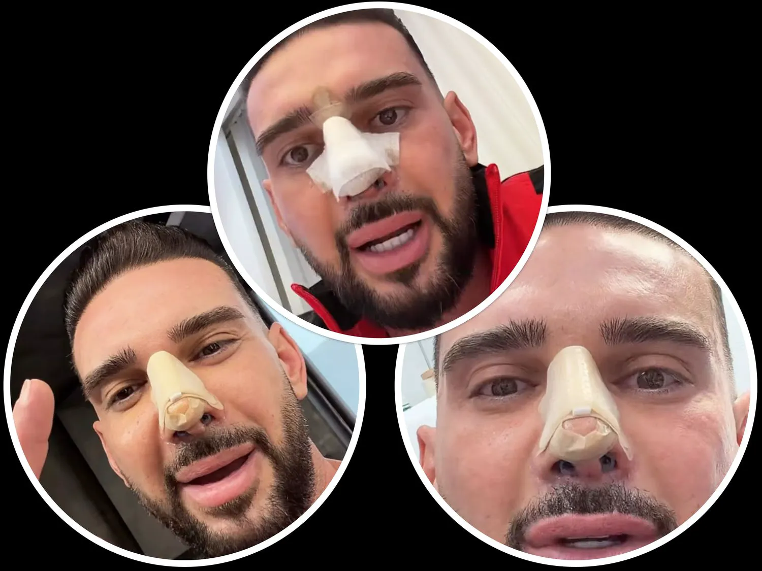 Dorian Popa a început să plângă după ce și-a văzut noul nas. Operația nu e încă vindecată – Video